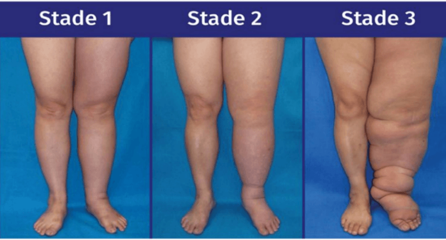 Stades évolution lymphoedème